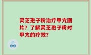灵芝孢子粉治疗甲亢图片？了解灵芝孢子粉对甲亢的疗效？